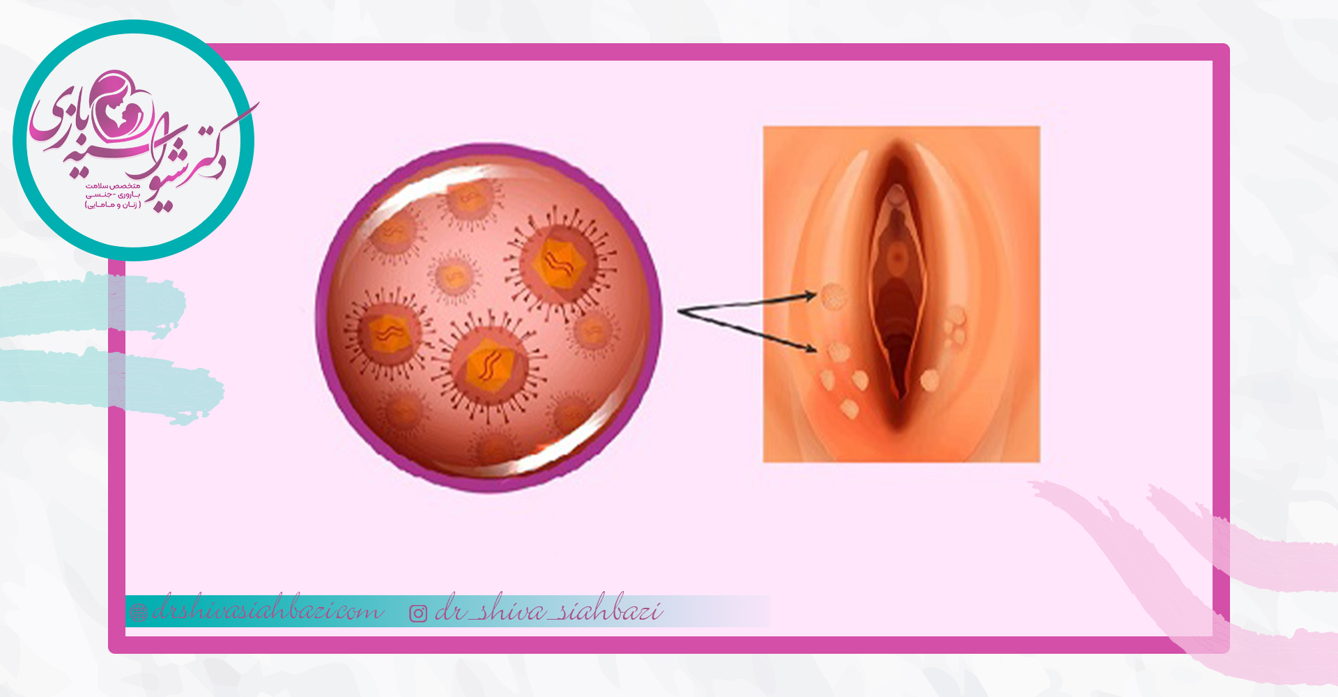 درمان صد درصدی زگیل تناسلی