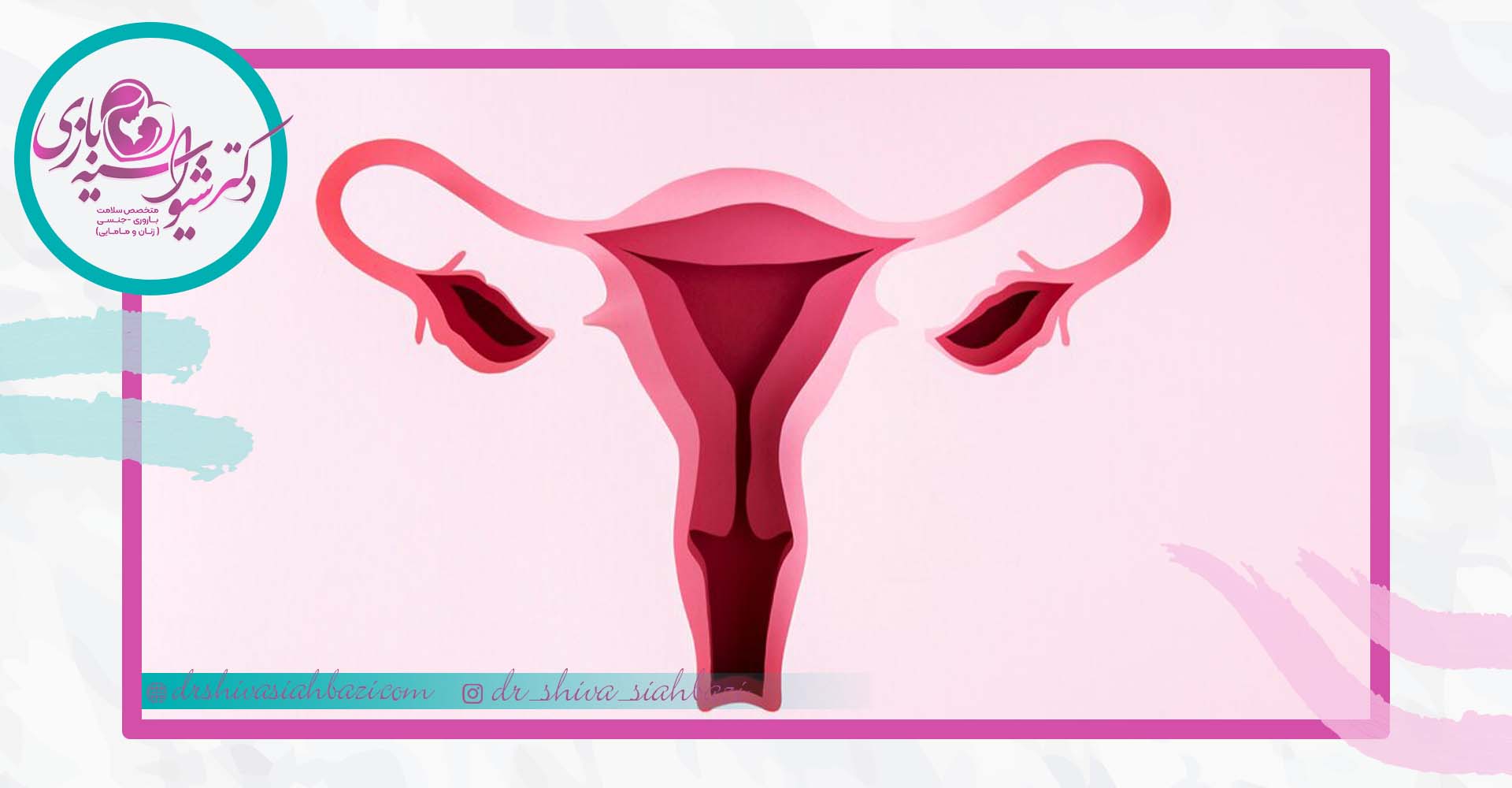 راه های پیشگیری از آندومتریوز