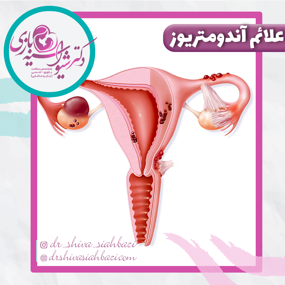 علائم آندومتریوز