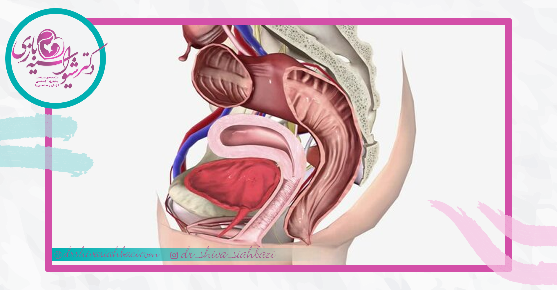 درمان افتادگی مثانه