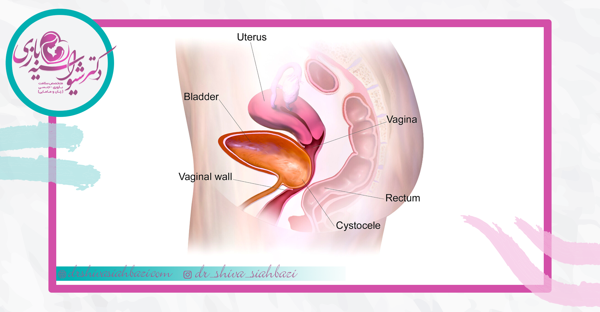 علائم افتادگی مثانه چیست؟
