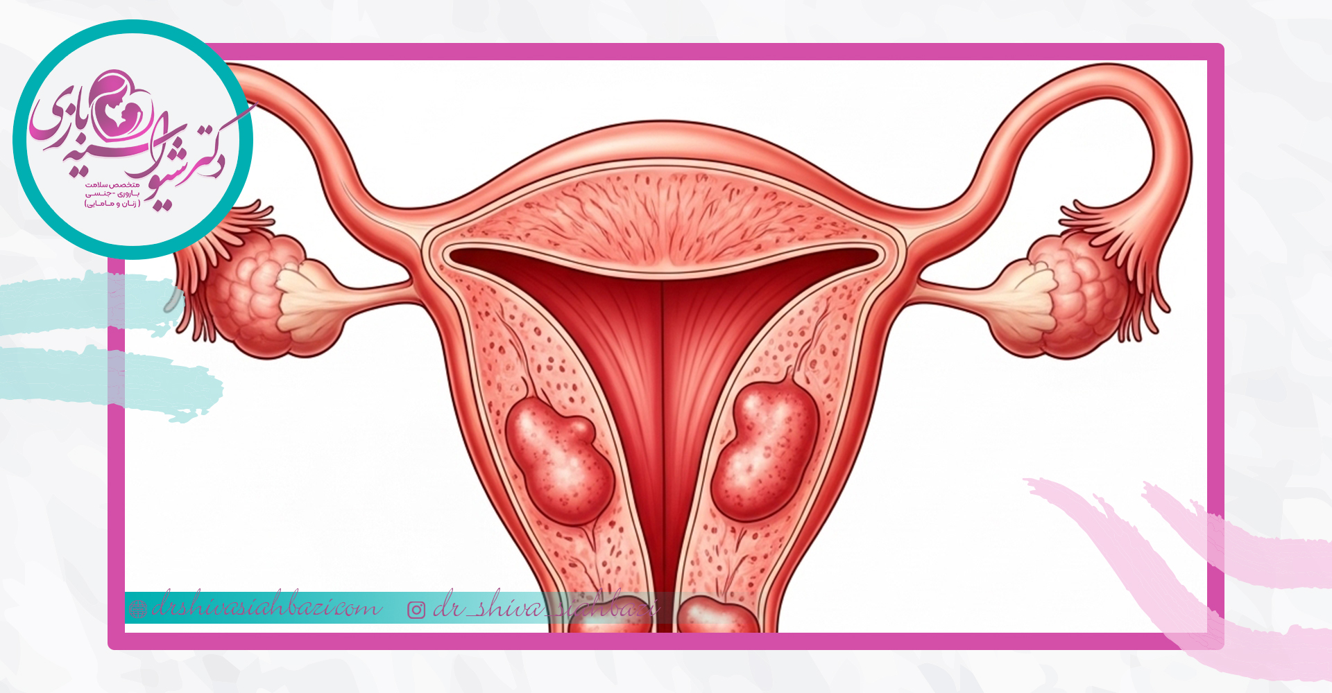 چسبندگی های رحم