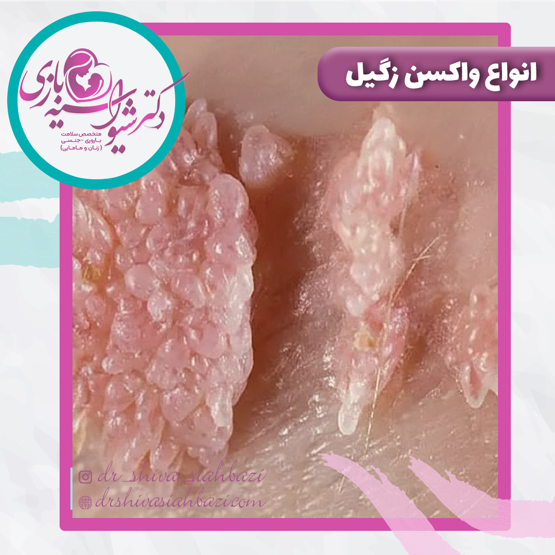 آشنایی با انواع واکسن زگیل تناسلی